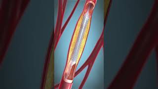 procedure of angioplasty shorts viralshorts [upl. by Assirehc]