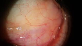 Prolapsed Orbital Fat and Conjunctival Cysts with Concretions [upl. by Ailefo]