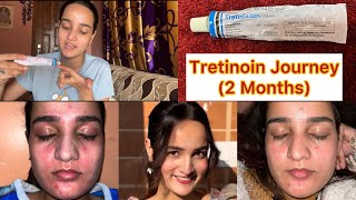 2 Month RetinolTretinoin Journey✨ [upl. by Catarina]