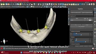 Planejamento Digital para Mandibula técnica Allon4 [upl. by Queena]