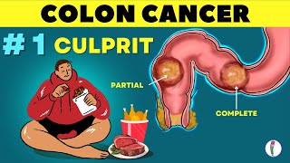 1 🔥 Cause of Colon Cancer amp how to prevent it  Colon Cancer  causes  Rectal cancer [upl. by Kraul]