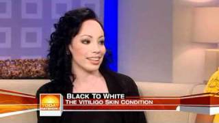 Girl with vitiligo talks about Michael Jackson [upl. by Ellirpa790]