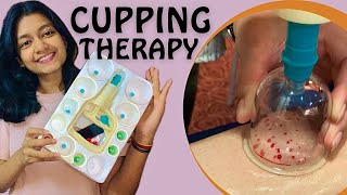 CUPPING THERAPY BENEFITS  PRACTICAL  THEORY [upl. by Odiug]