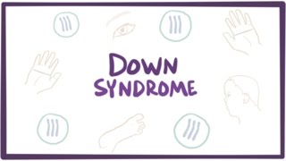 Down syndrome trisomy 21  causes symptoms diagnosis amp pathology [upl. by Ermina]