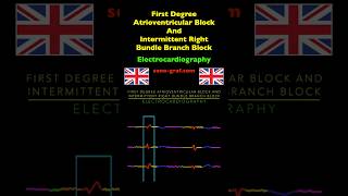 Electrocardiography  First Degree Atrioventricular Block And Intermittent Right Bundle Branch Block [upl. by Paschasia751]