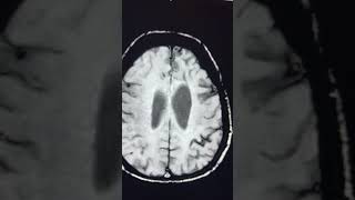 Significance of SWI  Superficial siderosis [upl. by Anihta59]