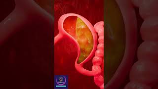 Gastroesophageal reflux disease  GERD Short Explanation [upl. by Inoy]