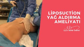 Liposakşın  Liposuction Yağ Aldırma Ameliyatı  OpDrTaner Bahar [upl. by Ayadahs650]