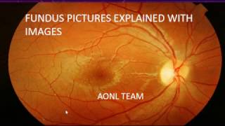 Fundus images explained by an ophthalmologist [upl. by Eisler]