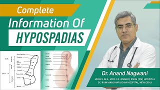 Complete Information about Hypospadias in Kolkata Hindi  वयस्क अधोमूत्रमार्गता  Dr Nagwani [upl. by Nerral]