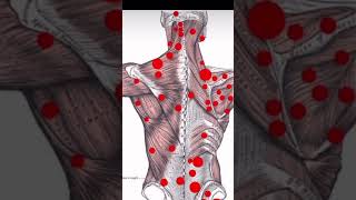 Trigger point therapy  Saara physio [upl. by Eciruam266]