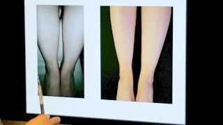 Ankle and leg sculpting with lasting results [upl. by Kolnick]