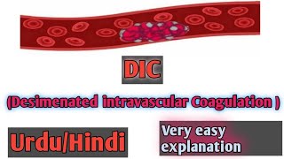 Desimenated intravascular coagulation DICEtiologyClinical featuresDiagnosisTreatmentIn Hindi [upl. by Akehsal]