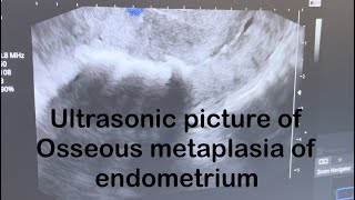 Ultrasound picture of Osseous metaplasia of endometrium [upl. by Tirb]