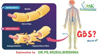 GuillainBarre Syndrome  GBS in Telugu  DrPSMuralikrishna  Nerves  neurologist [upl. by Leah855]