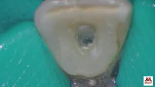 Preclinical Endodontics Maxillary anterior [upl. by Nipahc]