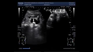 Multiple ureteric stones with multiple renal stones [upl. by Lrae]