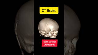 Ct brain Craniotomy Hydrocephalus ctbrain ctscan hydrocephalus craniotomy vp shunt brain [upl. by Marylynne664]