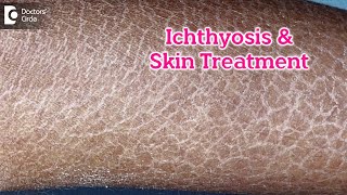 What is Ichthyosis How to Treat my Skin Fish like scales On SkinDrRasya Dixit  Doctors Circle [upl. by Roberta]