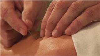 Acupuncture Treatments  Sciatica amp Acupuncture [upl. by Hammerskjold308]