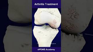 How to treat Arthritis best treatment for rheumatoid arthritis medicine [upl. by Davilman]