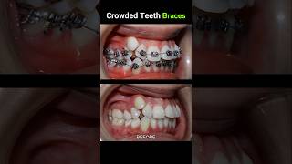 40 months for this braces Crowded teeth braces orthodontist dentist dentistry [upl. by Winstonn682]