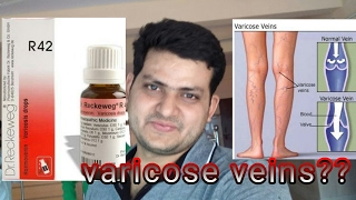 Homeopathic medicine for varicose veins explain [upl. by Elicec]