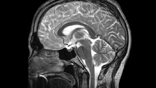 The Ventricles Neuroanatomy Video Lab  Brain Dissections [upl. by Asik126]