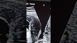 9 Weeks Pregnancy Ultrasound  9 Weeks Pregnancy Update  Bleeding During Pregnancy [upl. by Neuberger481]