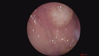 Central Nasopharyngeal Cyst [upl. by Anneliese310]