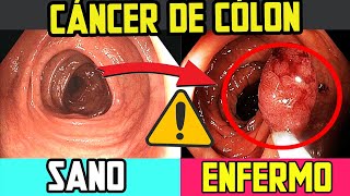 SI SIENTES ESTO tienes CANCER de COLON  SIGNOS INICIALES [upl. by Ecyor248]