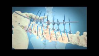 Scoliosis Surgical Correction with Instrumentation [upl. by Hoyt]