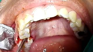 EXODONCIA DE MOLAR ENDODONCIADO 6 [upl. by Lynnelle]