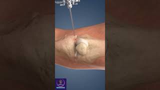 Knee Arthroscopy Procedure education shorts [upl. by Asennav]