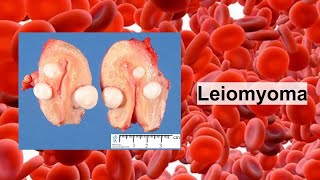 leiomyoma [upl. by Yenalem]