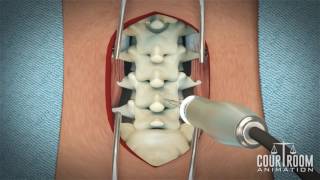 Lumbar Discectomy Surgery Medical Animation [upl. by Ahsaet266]