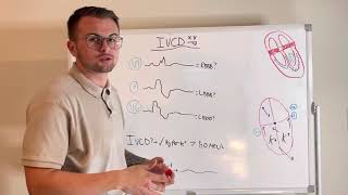 EKG Series How to quickly spot an IntraVentricular Conduction Delay IVCD and Hyperkalemia [upl. by Asenej]