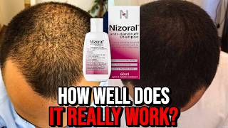 Ketoconazole Shampoo for Hair Growth  How Well Does it REALLY Work [upl. by Grover]