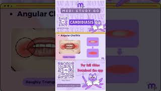 Angular Cheilitis  Oral Medicine  Medi Study Go [upl. by Laith]