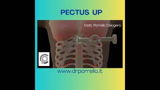 PECTUS UP DOTT PORRELLO [upl. by Sascha]